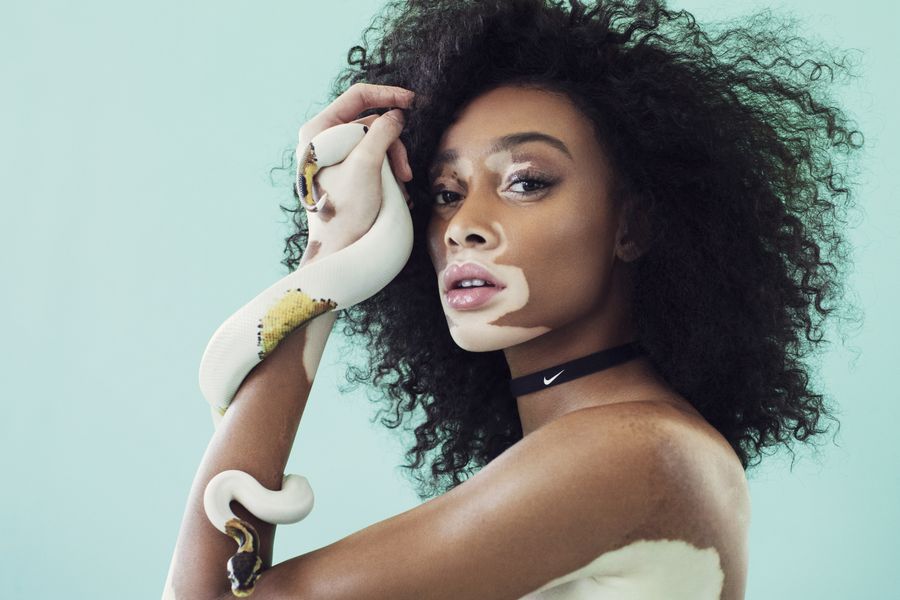 9 people with unique skin_Winnie Harlow